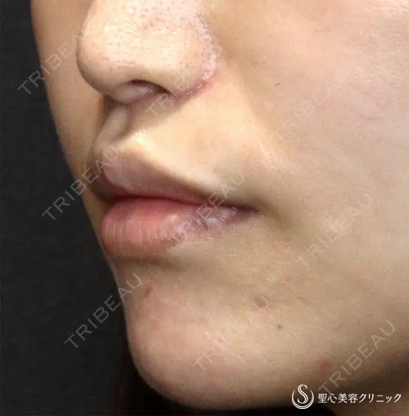【30代女性・口周りの印象をスッキリ】鼻下短縮術（リップリフト/人中短縮）（1ヶ月後）　 30日後 メイン用