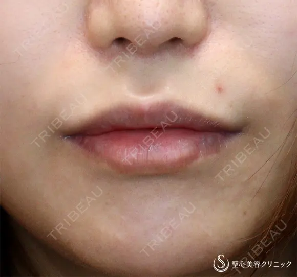 【30代女性・口周りの印象をスッキリ】鼻下短縮術（リップリフト/人中短縮）（1ヶ月後）　 before画像 メイン用