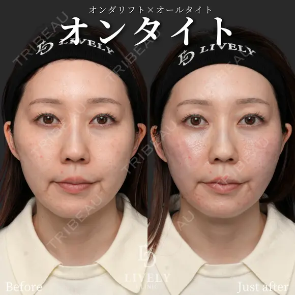 オンタイト（オンダリフト＋オールタイト） after画像 メイン用