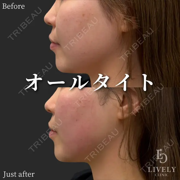 オールタイト before画像 メイン用
