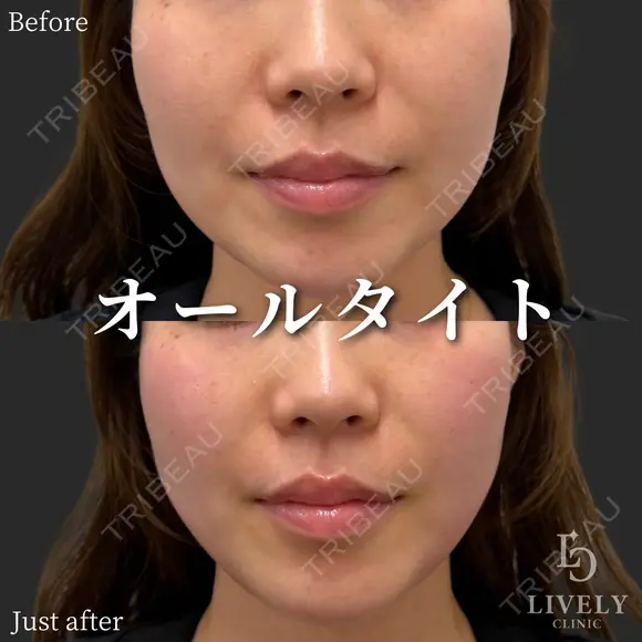 オールタイト after画像 メイン用