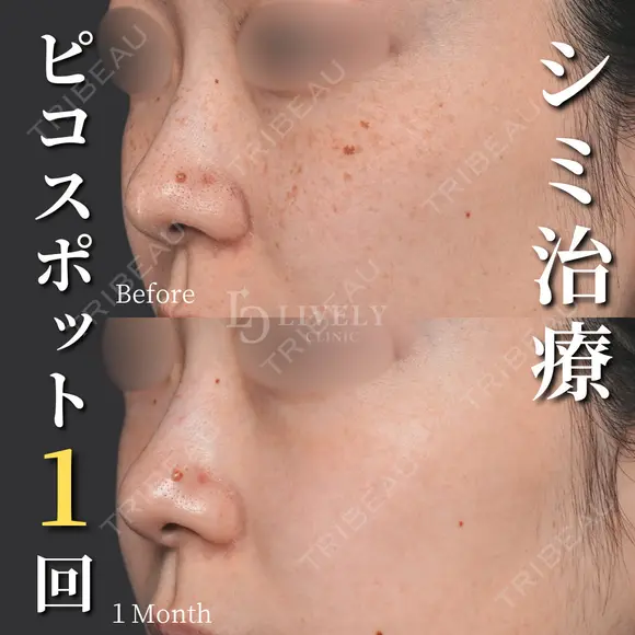 ピコスポット/シミ治療1回 after画像 メイン用