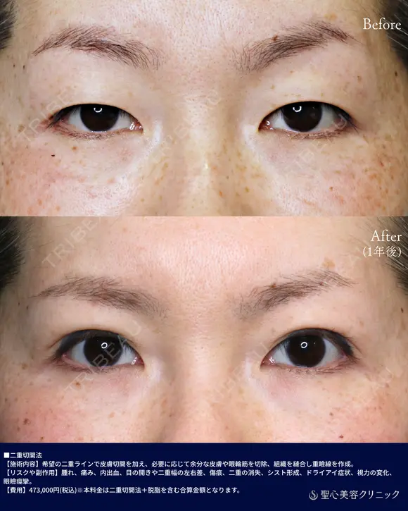 二重全切開 before画像 メイン用