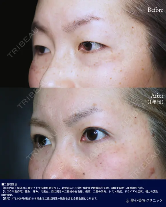 二重全切開 after画像 メイン用