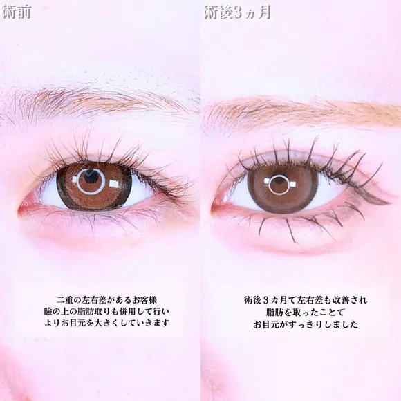アリエルクイックループトリプル二重埋没法/瞼の上の脂肪取り before画像 メイン用