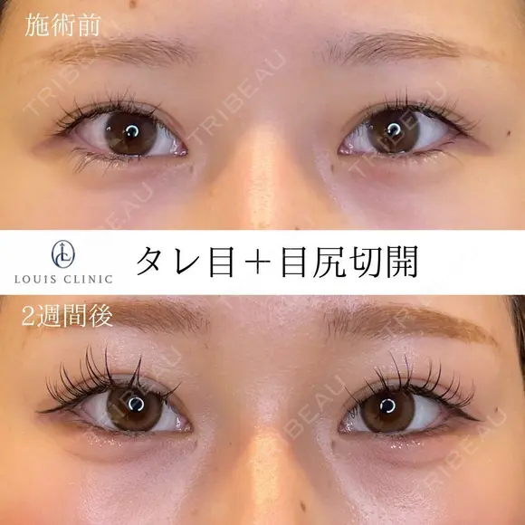 タレ目+目尻切開 before画像 メイン用