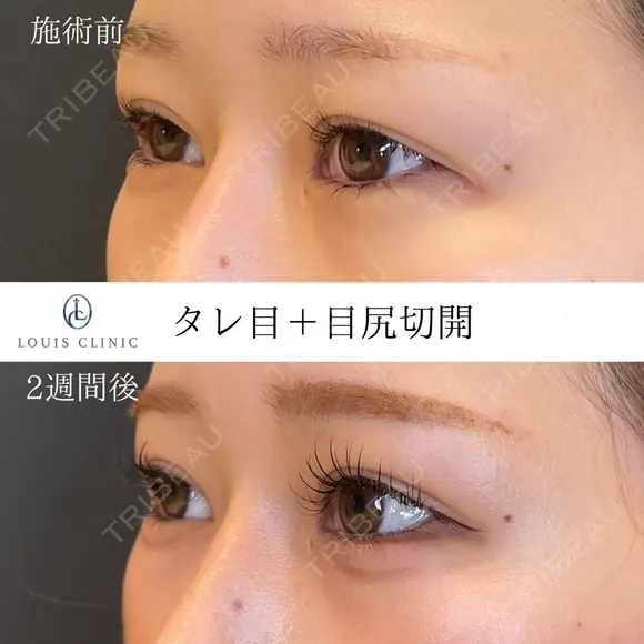 タレ目+目尻切開 14日後 メイン用
