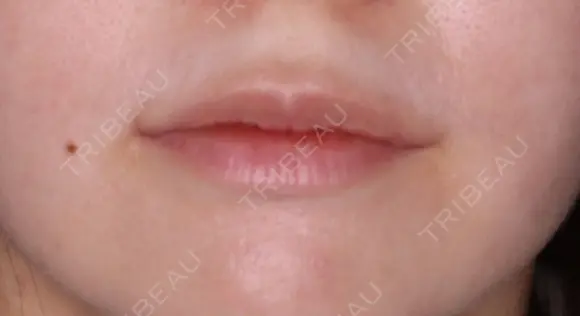 【20代女性・口角を挙げて自然に可愛らしく】プレミアム口角挙上術（1ヶ月後） after画像 メイン用