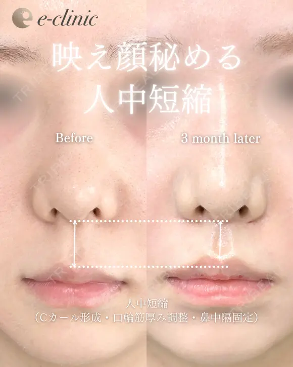 人中短縮 after画像 メイン用