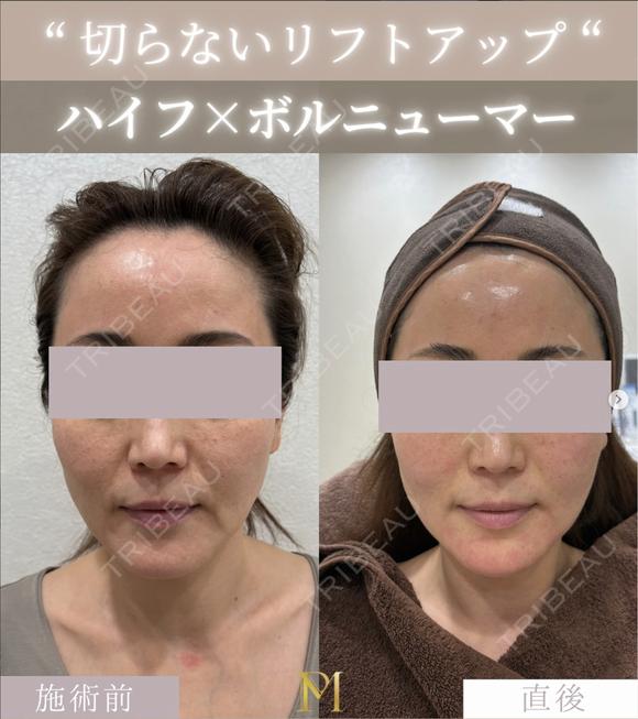 ハイフ×ボルニューマー after画像 メイン用