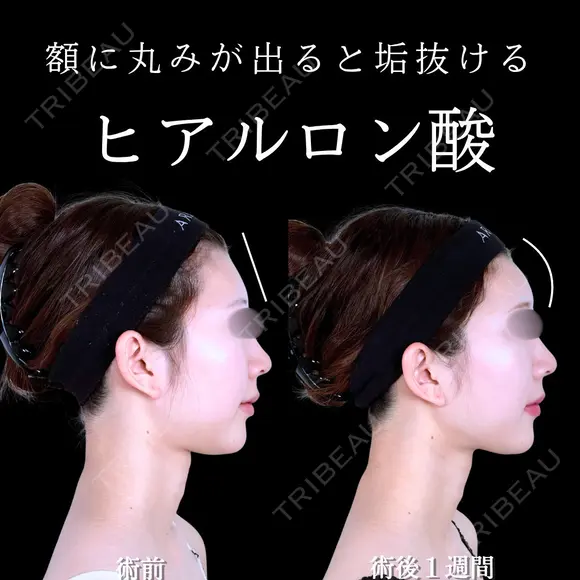 額ヒアルロン酸 7日後 メイン用
