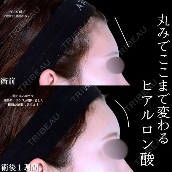 額ヒアルロン酸 before画像 メイン用