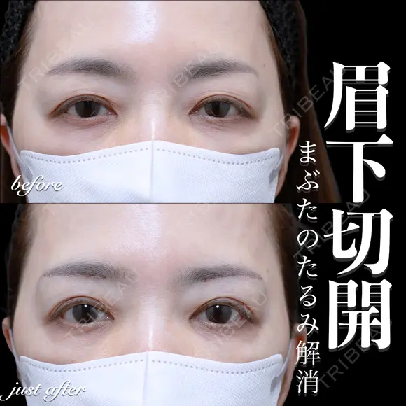 眉下切開 before画像 メイン用