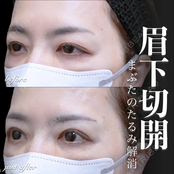 眉下切開 0日後 メイン用