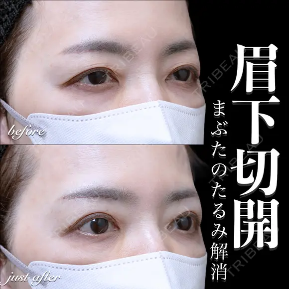 眉下切開 0日後 メイン用