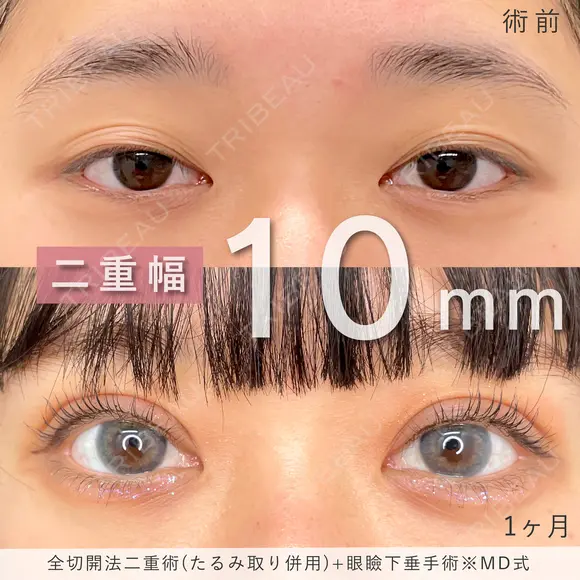 MD式全切開法二重術+MD式眼瞼下垂手術※たるみ取り併用 before画像 メイン用