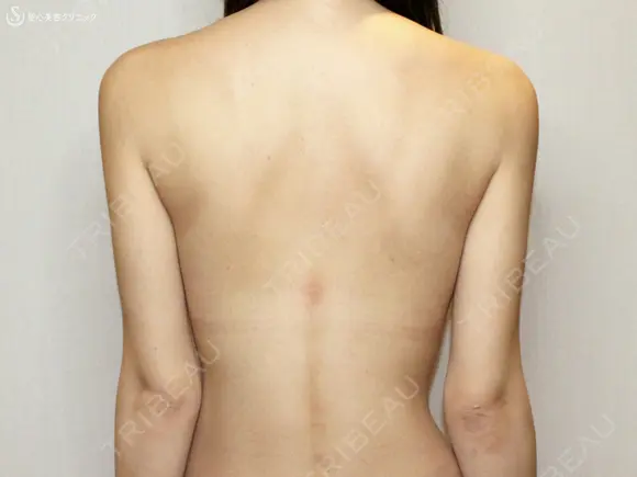 【20代女性・夏の「二の腕」のお悩み解消】ベイザー脂肪吸引（2年後） 730日後 メイン用