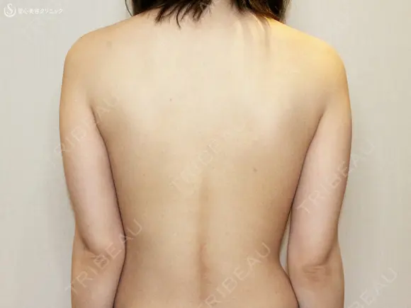 【20代女性・夏の「二の腕」のお悩み解消】ベイザー脂肪吸引（2年後） before画像 メイン用