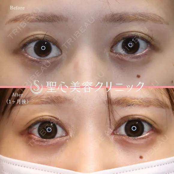 【20代女性・目頭目尻を横方向にしっかり伸ばしたい】目頭切開・目尻切開 before画像 メイン用