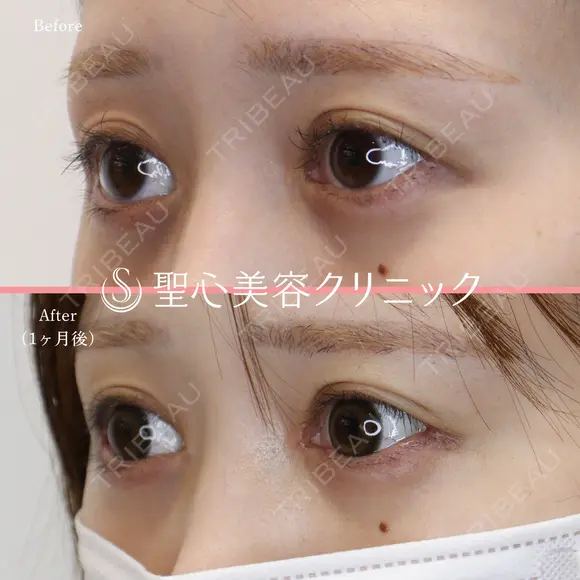 【20代女性・目頭目尻を横方向にしっかり伸ばしたい】目頭切開・目尻切開 after画像 メイン用