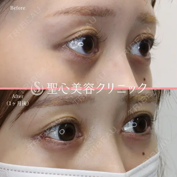 【20代女性・目頭目尻を横方向にしっかり伸ばしたい】目頭切開・目尻切開 after画像 メイン用