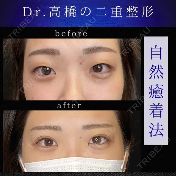 二重埋没(自然癒着) after画像 メイン用