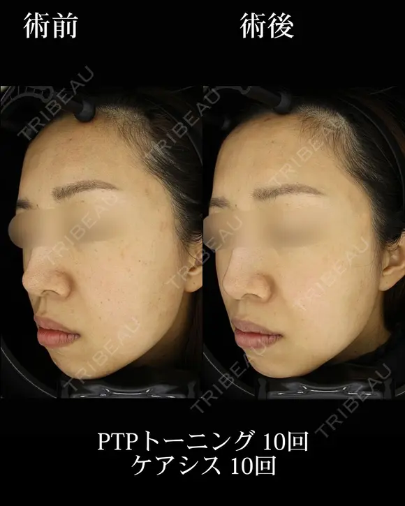PTPトーニング/ケアシス before画像 メイン用