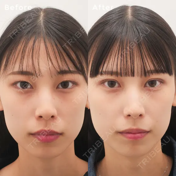 埋没法プレミアム before画像 メイン用