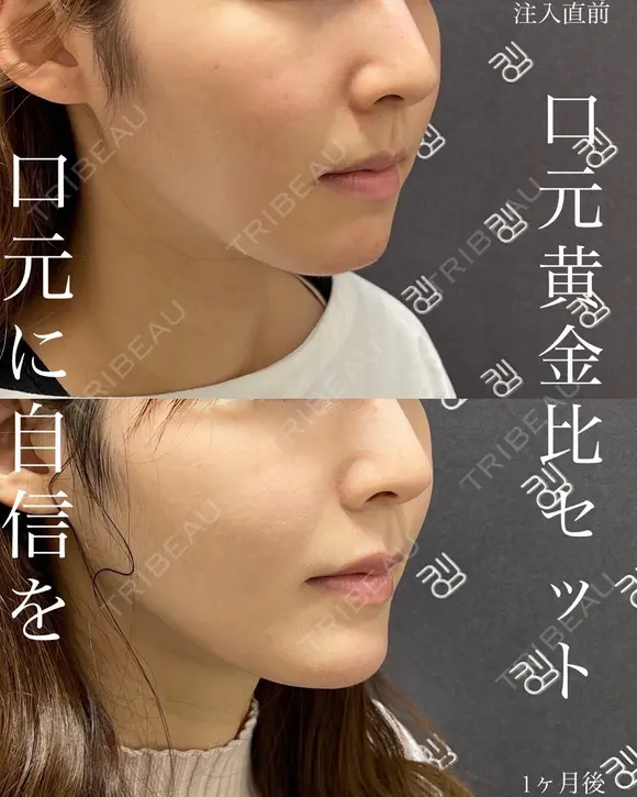 【切らない人中短縮】1か月後！もうマスクオフも怖くない！ before画像 メイン用