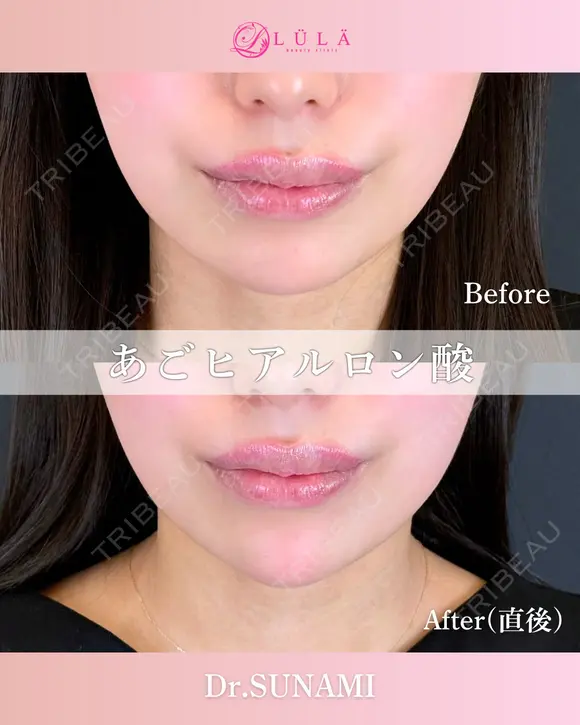 顎ヒアルロン酸 before画像 メイン用