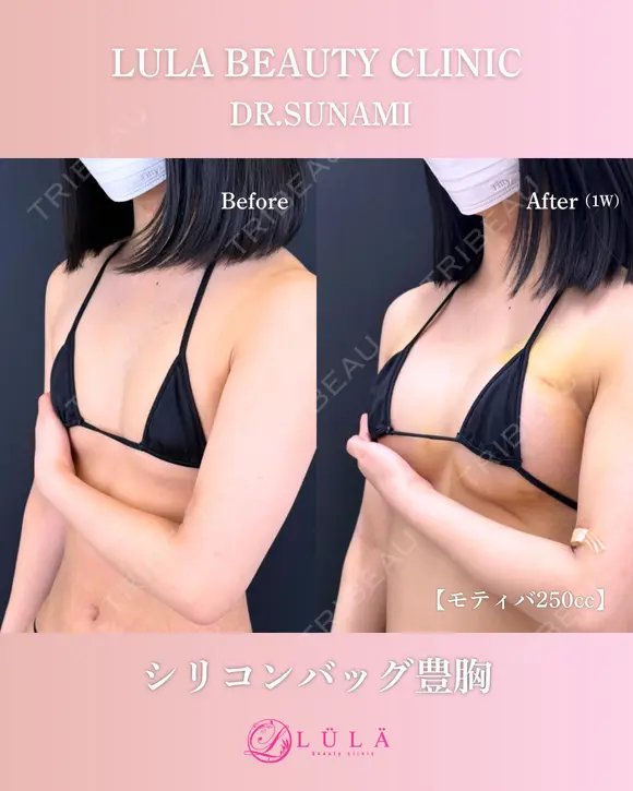 シリコンバッグ豊胸 before画像 メイン用