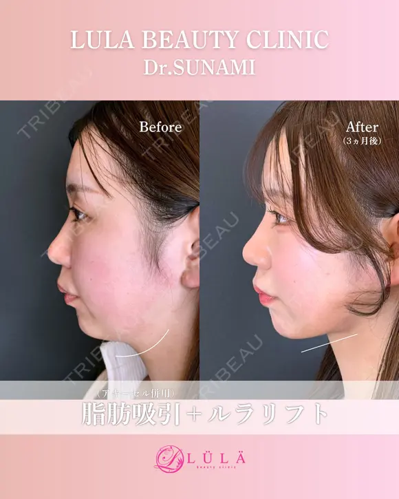 顔脂肪吸引×ルラリフト before画像 メイン用