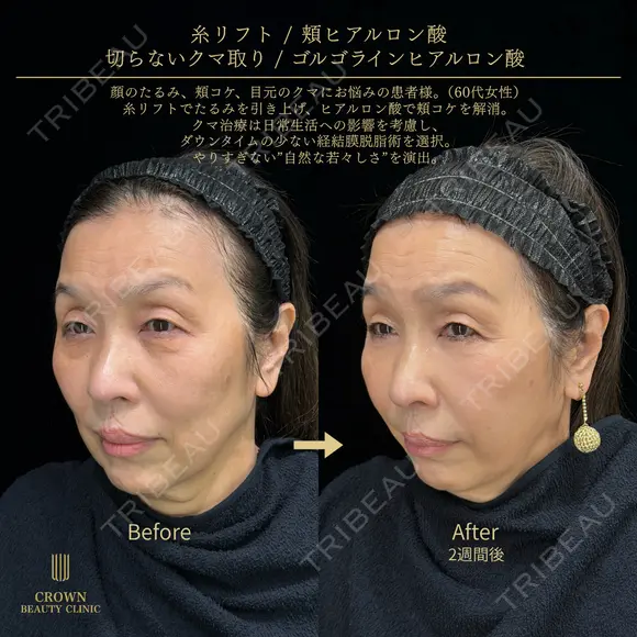 糸リフト・切らないクマ取り・頬ヒアルロン酸・目の下ヒアルロン酸 before画像 メイン用