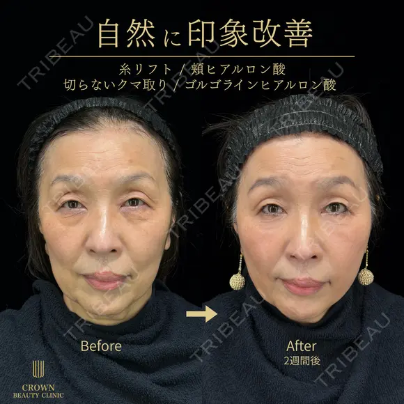 糸リフト・切らないクマ取り・頬ヒアルロン酸・目の下ヒアルロン酸 14日後 メイン用