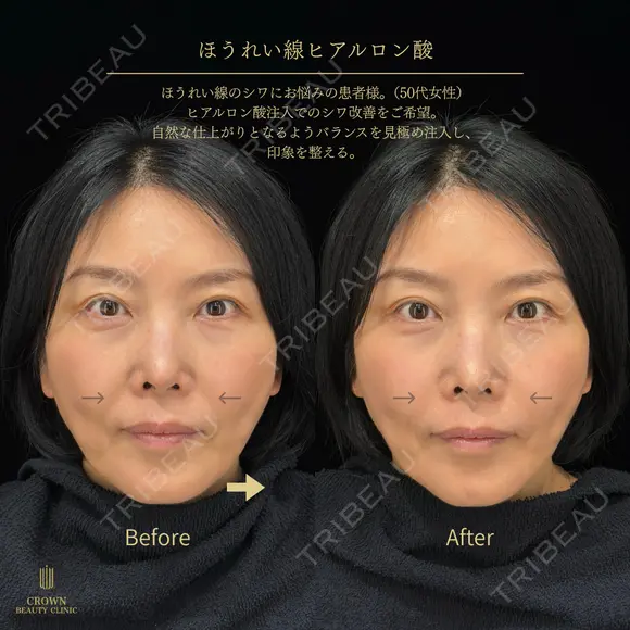 ほうれい線ヒアルロン酸 before画像 メイン用