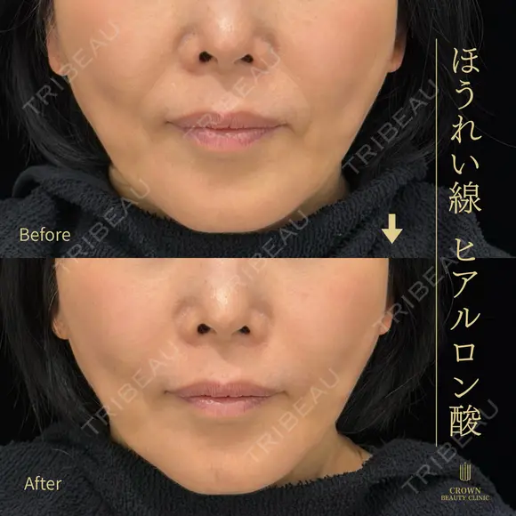 ほうれい線ヒアルロン酸 0日後 メイン用