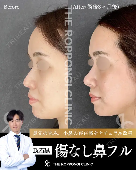 鼻先の丸み、小鼻の存在感をナチュラル改善 before画像 メイン用