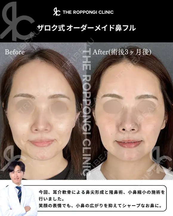 鼻先の丸み、小鼻の存在感をナチュラル改善 90日後 メイン用