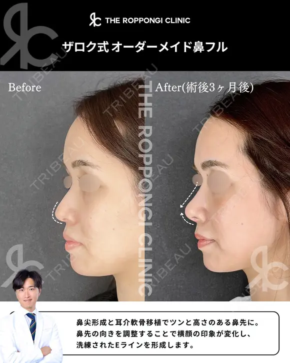 鼻先の丸み、小鼻の存在感をナチュラル改善 90日後 メイン用