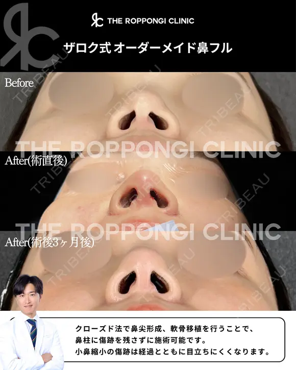 鼻先の丸み、小鼻の存在感をナチュラル改善 90日後 メイン用