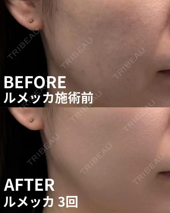 ルメッカ(3周) after画像 メイン用