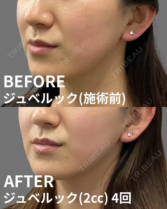 ジュベルック(2cc) after画像 メイン用