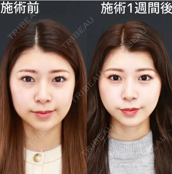 糸リフト+唇ヒアルロン酸+涙袋ヒアルロン酸+エラボトックス after画像 メイン用