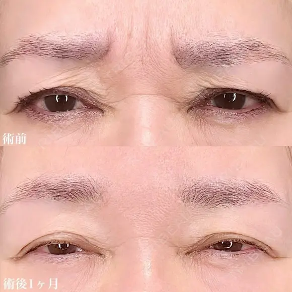 眉間ボツリヌストキシン注射 before画像 メイン用