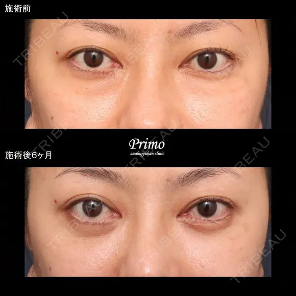 G 下眼瞼切開術（裏ハムラ法） 180日後 メイン用