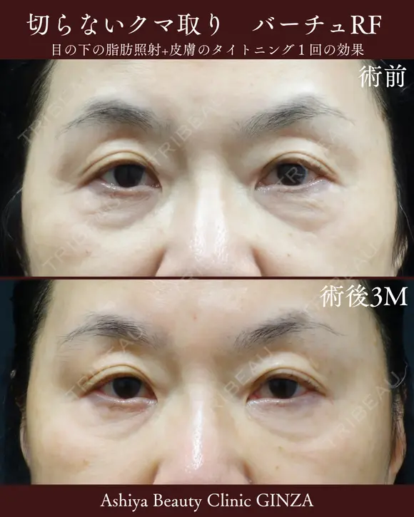 切らないクマ取り　バーチュRF （ニードルRF） before画像 メイン用
