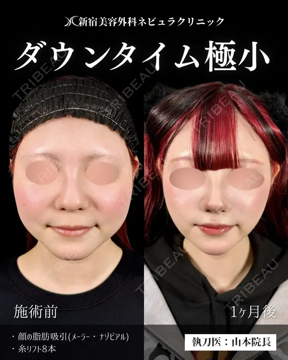 山本の🎀脂肪吸引🎀 after画像 メイン用