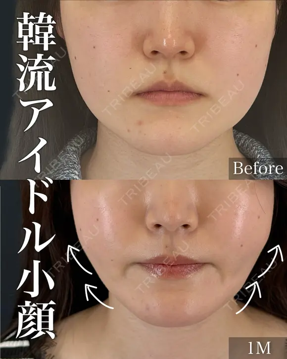 美ボディ脂肪吸引（ほほ）＋VOVリフト（6本） after画像 メイン用