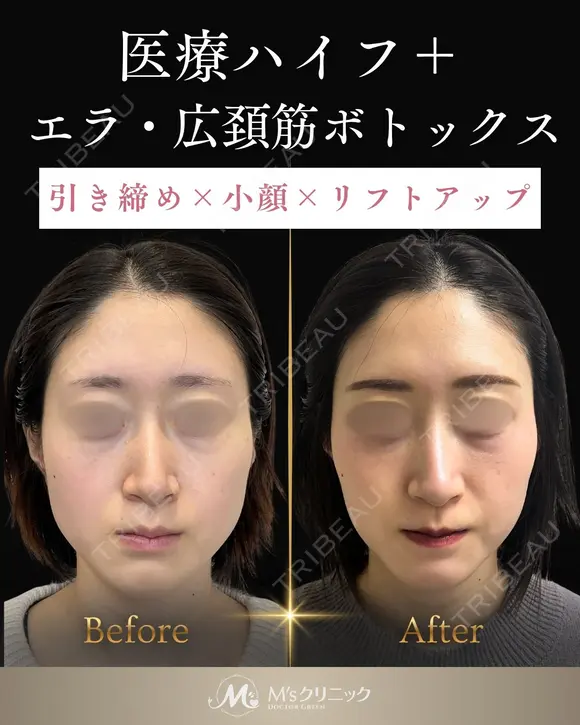 ウルトラフォーマーⅢ×エラボトックス×広頚筋ボトックスでフェイスラインをトータル改善✨ before画像 メイン用