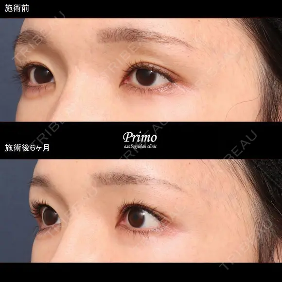 HP 眼瞼下垂手術＋下眼瞼拡大術＋目尻切開 before画像 メイン用